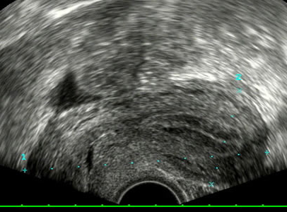 Ecografía Ginecológica